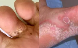 Sốt và bệnh da liễu gia tăng sau bão lũ: Khuyến cáo cẩn trọng khi dọn dẹp môi trường