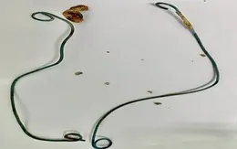 Cảnh báo người bệnh đặt thông JJ sau tán sỏi: đừng quên tái khám đúng hẹn