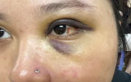 Đang uống cà phê, người phụ nữ ở Hà Nội bị đánh gãy xương hốc mắt