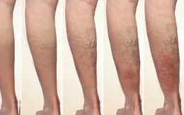 Suy tĩnh mạch chi dưới: Hiểu đúng để phòng ngừa và điều trị hiệu quả
