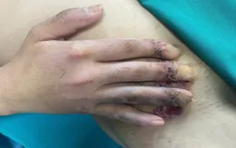 Hồi sinh bàn tay cho người bệnh có nguy cơ phải tháo khớp ngón tay