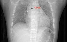 Bé trai 13 tuổi nguy kịch vì hít phải đinh ghim khi ngậm trong miệng