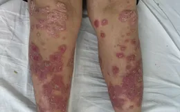 Vảy nến - Căn bệnh da liễu không đơn giản chỉ là bong tróc da