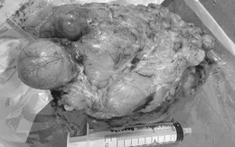 Bóc thành công khối u mỡ “khủng” cho bệnh nhân mang u phổi nguy hiểm