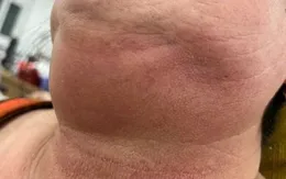 Cảnh báo nhiễm trùng răng miệng ở người bệnh đái tháo đường