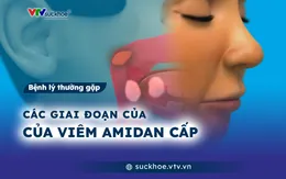Các giai đoạn của viêm amidan cấp