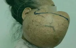 Gỡ bỏ khối u khổng lồ hơn 40 năm trên mặt người phụ nữ dân tộc Thái