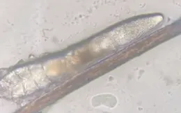 "Bắt sống" ký sinh trùng trên mi mắt bệnh nhân