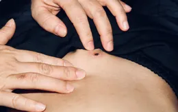 Cụ bà mắc sốt mò biến chứng suy đa phủ tạng