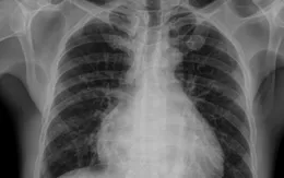 Tổn thương phổi - nguyên nhân hàng đầu gây tử vong liên quan truyền máu