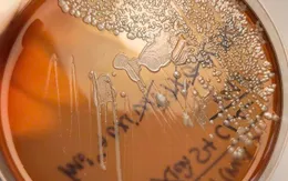 Cảnh giác với bệnh Whitmore