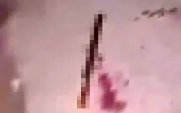 Nam thanh niên 17 tuổi ở Lâm Đồng bị chém đứt lìa bàn tay