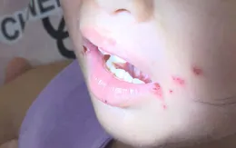 TP Hồ Chí Minh ghi nhận hơn 3.200 ca sốt xuất huyết và tay chân miệng trong tuần 44