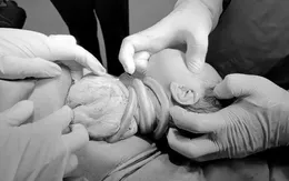 Bé gái chào đời an toàn dù có 6 vòng dây rốn quấn cổ, mẹ bị tiền sản giật