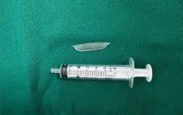 Gắp thành công dị vật sắc nhọn xuyên thủng thực quản sát động mạch chủ