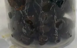 Lấy hơn 100 viên sỏi túi mật cho nữ bệnh nhân 35 tuổi