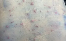 Cảnh báo thủy đậu ở người lớn có thể gây biến chứng nguy hiểm