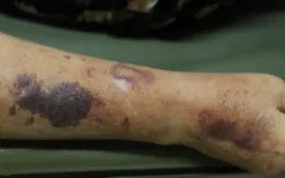 Cảnh báo nguy hiểm từ việc tự ý dùng thuốc corticoid