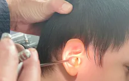 Gia tăng ca viêm tai giữa mủ ở trẻ em