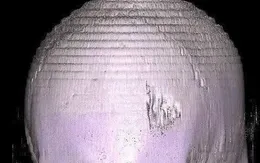 Quên đội mũ bảo hộ, người đàn ông bị vỡ lún xương sọ, suýt mất mạng