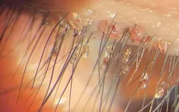 Ngứa mi mắt dai dẳng, coi chừng rận mu "lạc chỗ"