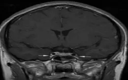 Cảnh báo viêm tắc tĩnh mạch xoang hang: Căn bệnh hiếm nhưng tử vong cao