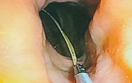 Cảnh báo nguy cơ thủng tạng rỗng do dị vật tiêu hóa