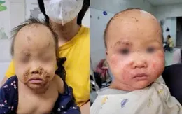 Bé gái 10 tháng tuổi dị ứng thuốc nhỏ mắt, nhập viện vì viêm da nặng