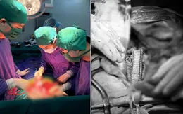 Phẫu thuật thay khối phình động mạch chủ bụng, xử trí sỏi mật trong một ca mổ