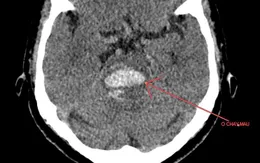 Chảy máu não do tăng huyết áp