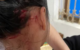 Cảnh báo nguy hiểm khi trẻ bị chó cắn