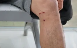 Tử vong do bệnh dại vẫn xảy ra: Khuyến cáo tiêm vaccine ngay khi bị chó cắn