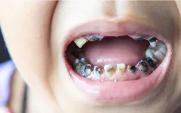 Trẻ nhập viện vì viêm tấy lan tỏa vùng mặt do răng