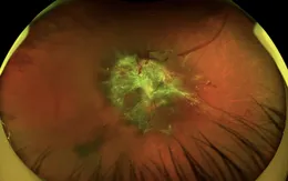 Đừng để tiểu đường cướp đi ánh sáng