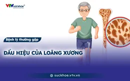 Dấu hiệu của loãng xương