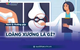 Loãng xương là gì?