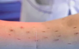 "Cứu" trị đau lưng tại nhà: Cẩn trọng tránh bỏng nhiệt