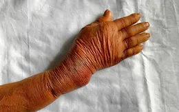 Cảnh báo nguy hiểm từ bó thuốc nam "chữa gãy xương"