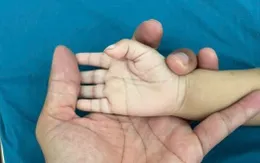 Bé 13 tháng tuổi nguy kịch vì thiếu máu nặng do thiếu sắt