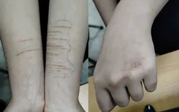 Tự gây thương tích ở trẻ vị thành niên: Xu hướng gia tăng đáng báo động