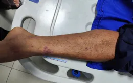 Tăng giám sát, chủ động phòng bệnh do não mô cầu