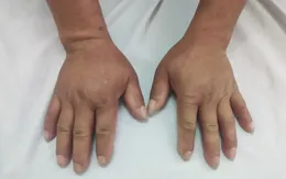 Phù tay chân kéo dài hé lộ ca xơ cứng bì hệ thống