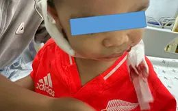 Cấp cứu bé 2 tuổi bị chó nhà cắn vào mặt