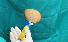 Tràn dịch màng phổi, phù phổi cấp do suy tim