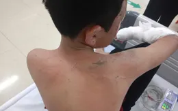 Trẻ bỏng nặng vì tự đốt pháo: Cảnh báo nguy hiểm dịp cận Tết