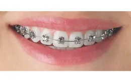 Bọc răng sứ có niềng răng được không? Nha Khoa Đăng Lưu giải đáp