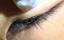 Phát hiện ổ ký sinh trùng ở mi mắt trẻ 5 tuổi