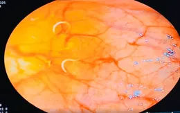 Rối loạn tiêu hóa kéo dài, đi khám phát hiện giun tóc ký sinh đại tràng