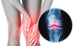 Trời lạnh, đau cơ xương khớp tăng: Chủ động chăm sóc để giảm đau