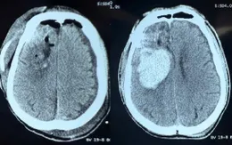 Ngã sau cơn động kinh, bệnh nhân xuất huyết não nguy kịch